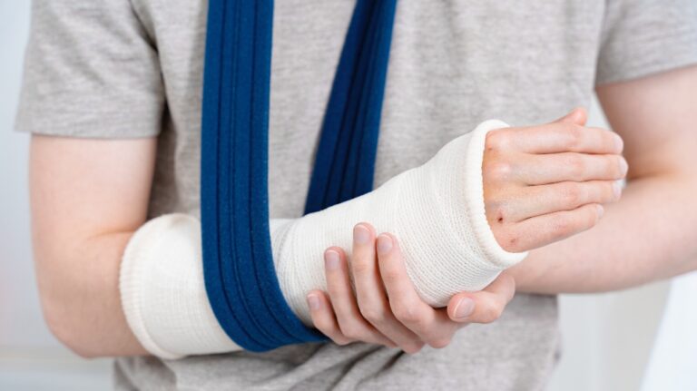 person with a broken arm in a white cast
